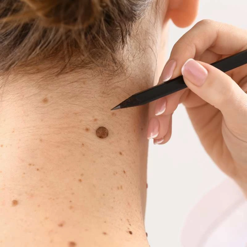 How to Support Your Body During Pregnancy for Faster Postnatal Recovery 5 See our lesion removal prices Chipping Norton - call today for a free quote